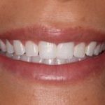 Before Veneers Close Up