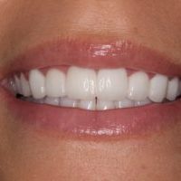 After Veneers Close Up