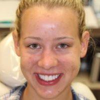 Ricarda After Veneers