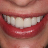 Ricarda After Veneers