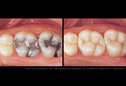 Tooth Colored Fillings