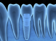 Digital Dental Implant