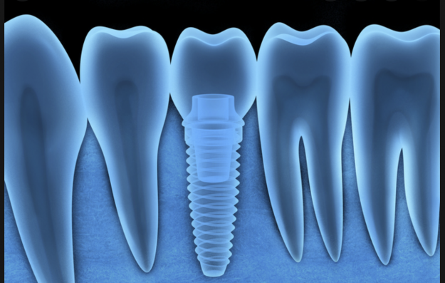 Digital Dental Implant
